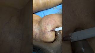 Live Sclerotherapy Watch How Its Done ✨ sclerotherapy spiderveintreatment shortsfeed shorts [upl. by Casar]