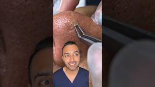 OMG I was not expecting that blackhead extraction on the nose Dr Somji reacts [upl. by Nosiaj]