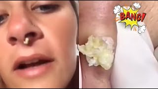 Super Satisfying Acne Removal Compilation Best Pops Blackheads and Cyst Extractions [upl. by Schoof]