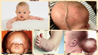 10 COMMON BIRTH DEFECTS  GENETIC DEFECTS IN PREGNANCY  WHAT ARE BIRTH DEFECTS [upl. by Nnaihs325]