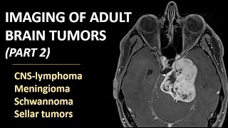 Imaging of brain tumors part 2 CNSlymphoma meningioma schwannoma and sellar tumors [upl. by Suhail]