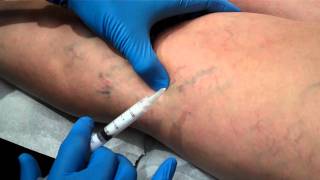 Foam Sclerotherapy superficial varicose vein by Dr Khalil Fattahi MD [upl. by Jenelle]