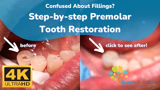 Confused About Fillings Simple StepByStep Restoration of a Large Premolar Tooth Filling [upl. by Ecart]