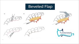 BEVELED FLAP PERIODONTAL FLAP SURGERY ON PALATAL ASPECT MODIFICATION OF APICALLY REPOSITIONED FLAP [upl. by Bigelow]