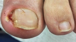 como sacar uña encarnada  como obter uma unha encravada  Impacted or Ingrown Toenail Pedicure [upl. by Refotsirhc]