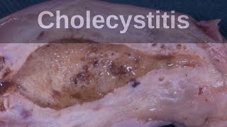 Cholecystitis and Strawberry Gallbladder  Pathology mini tutorial [upl. by Ande]