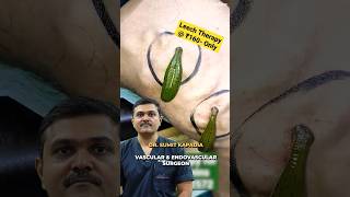 Leech Therapy for Varicose Veins Does it work shorts [upl. by Trant]