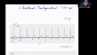 Quick Junctional Rhythms Review Paramedic Cardiology [upl. by Latsyrd]