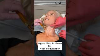 Hyperdilute Radiesse for Neck Rejuvenation hyperdiluteradiesse neckrejuvenation [upl. by Egedan49]