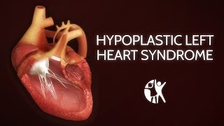 Hypoplastic Left Heart Syndrome HLHS [upl. by Sam]