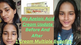 My Azelaic Acid Cream 10 Update  Before And After  Azidem Cream  1 Cream Multiple Benefits [upl. by Arnuad]