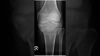 tibia bone fracture and after plating reducedlikeshareandsubscribadvance hospitaldoctor [upl. by Hasen]