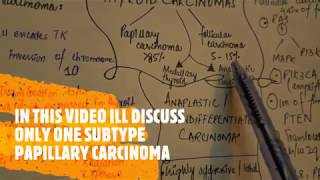 Thyroid carcinoma  papillary carcinoma [upl. by Ailimac632]