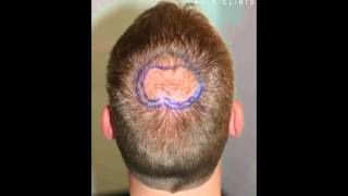 Haartransplantation FUE 1500 Tonsur [upl. by Lemhaj]