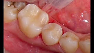 Kompozit dolgular Composite fillings [upl. by Bigot]