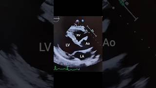 Parasternal Long Axis PLAX view with Color Flow Doppler echocardiography [upl. by Ytoc926]