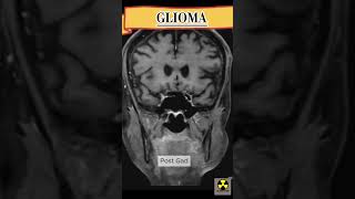 MRI Brain  GLIOMA mriscan medicalimaging See description [upl. by Gentes]