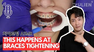 ASMR  This is What Braces Tightening Looks Like [upl. by Nic]