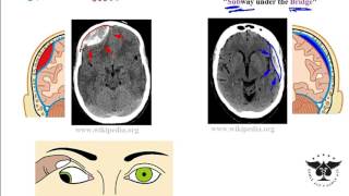 Hemorrhagic stroke epidural amp subdural hematoma  USMLE Step 1 [upl. by Aikal]