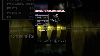 Pulmonary Stenosis on Echocardiography anatomy cardiology shorts [upl. by Auqinal837]