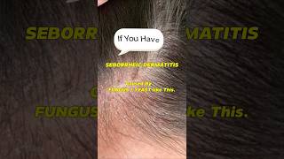 Seborrheic Dermatitis How to treat your Scalp itchyscalp shorts dandruff seborrheicdermatitis [upl. by Nnednarb]