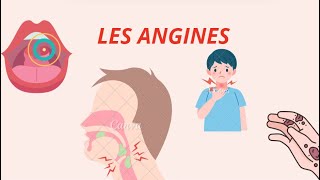 Angines  Types Symptômes et Traitements – Tout ce quil Faut Savoir [upl. by Aneehsirk249]