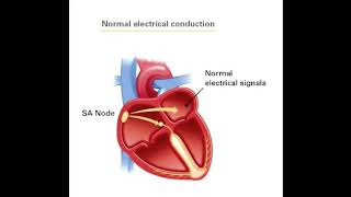 Sick sinus syndrome [upl. by Moselle]