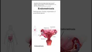 Endometriosis [upl. by Karrah]