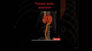 Thoracic Aorta Aneurysm  CECT Chest shorts aorticaneurysm radiology [upl. by Odlonra]