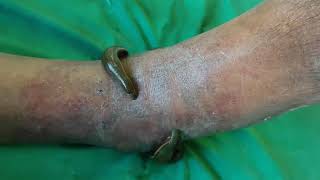 Leech Therapy in Palmoplantar Psoriasis by Dr Bijendra Shah [upl. by Tayib]