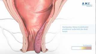 Hämorrhoiden Information Ursachen und Symptome [upl. by Yarised378]