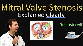 Mitral Valve Stenosis Diagnosis Treatment Pathophysiology [upl. by Glenine]