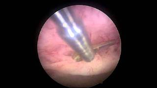 Endometrial polyp [upl. by Xineohp]