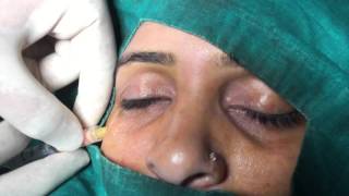 Nano Fat Injection for Under Eye Dark Circles [upl. by Margarita]