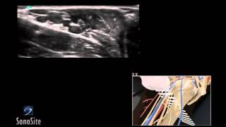 How To Ultrasound Guided Axillary Nerve Block 3D Video [upl. by Bello]