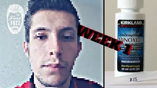 Minoxidil Beard  Week 1  Minoxidil 5 for Beard Growth  Facialfuzzfridays [upl. by Isidor]