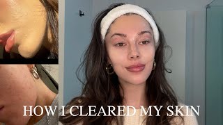 How I cleared my skin [upl. by Analihp]