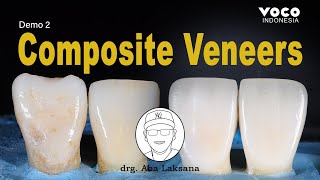 Anterior Composite Veneers Restoration with Layering Technique  AMARIS VOCO GmbH [upl. by Icyak723]