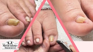 Ingrown Toenail Pedicure [upl. by Nomsed]