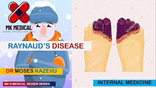 Raynauds disease [upl. by Notserk]