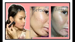 Microneedling Before and After  Q and A  Derma Pen vs Derma Stamp [upl. by Ilona964]