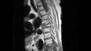 benign compression fracture MRI [upl. by Abe673]