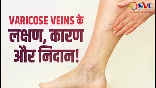 VARICOSE VEINS  SYMPTOMS  CAUSES  TREATMENTS  VARICOSE VEINS SPECIALIST [upl. by Gable]