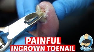 EXTREME PAINFUL INGROWN TOENAIL REMOVALDID IT HURT TO REMOVE IT [upl. by Aneelahs122]