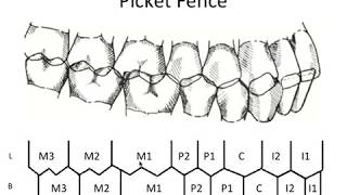 STATIC OCCLUSION  Occlusal Contacts amp Picket Fence [upl. by Eiclehc]