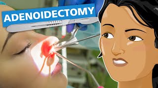 Adenoidectomy [upl. by Nomelif]