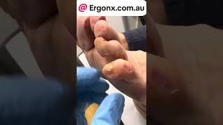 5th toe corn and callus removal by podiatrist satisfyjng to watch but very painfulhave [upl. by Ymmaj]