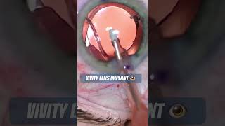 Vivity Lens Implant cataractsurgery [upl. by Healy42]