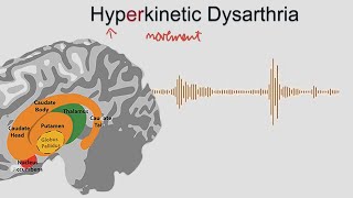 Hyperkinetic Dysarthria  samples and explanation [upl. by Amerak]