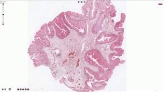 Condyloma  Histopathology [upl. by Remle]